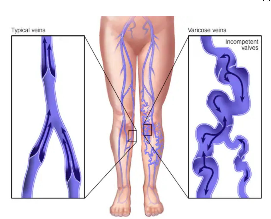varicose veins