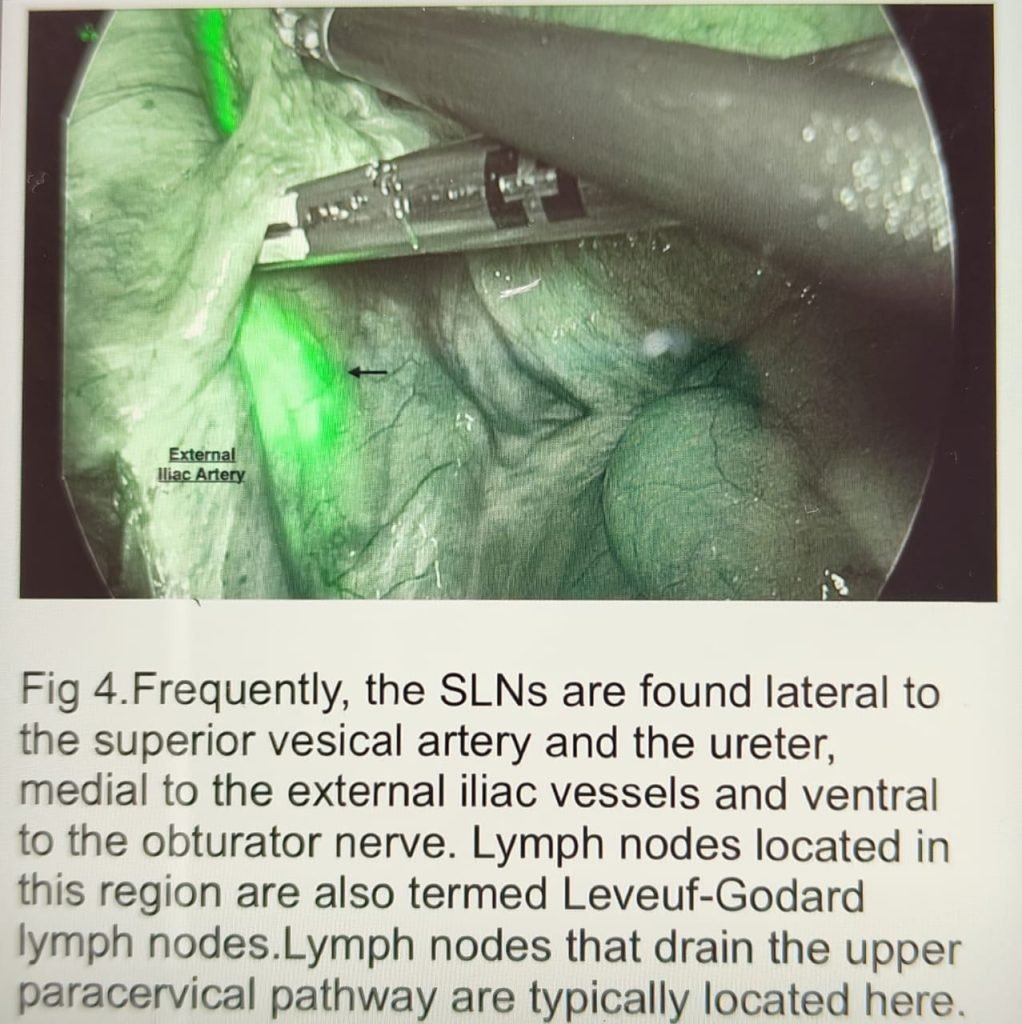 ICG guided cancer surgery 