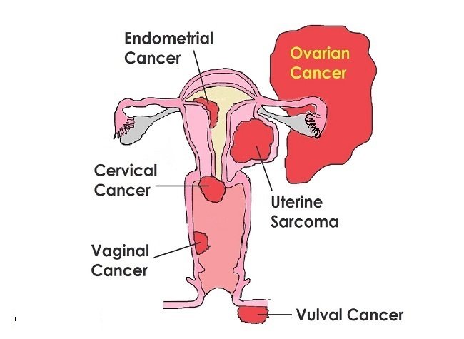 Gynae Cancer Surgery